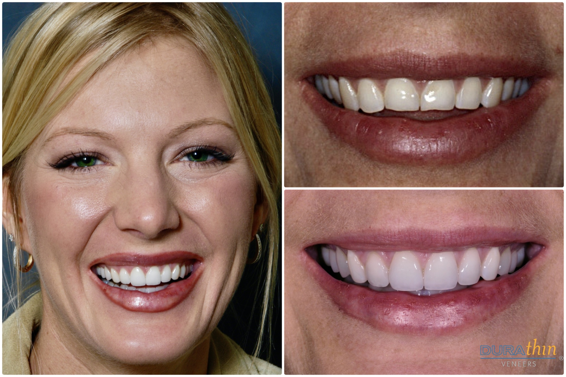 About Us – Durathin Prepless Veneers