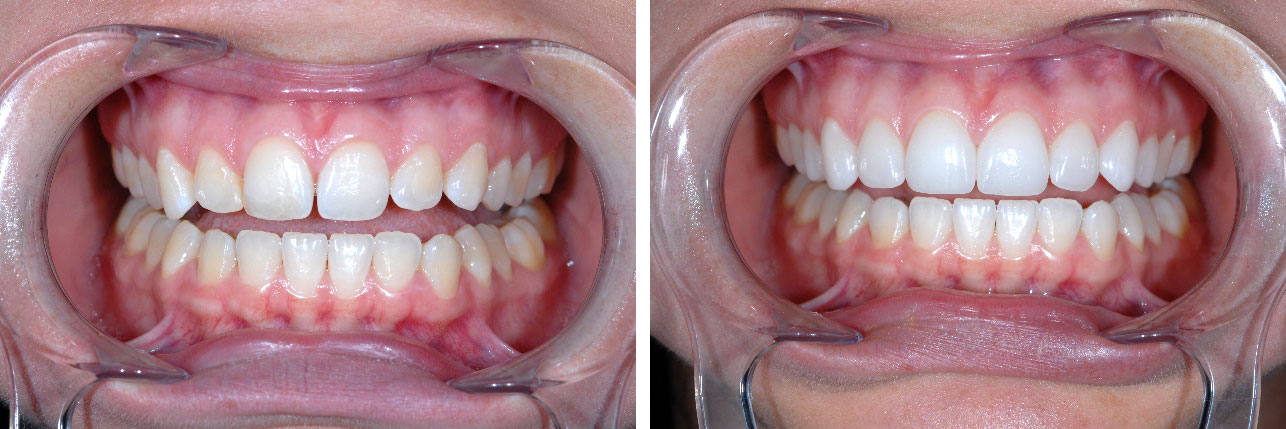 Before And Afters – Durathin Prepless Veneers