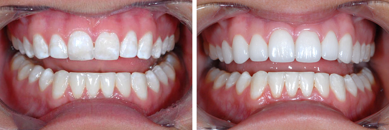 Before And Afters – Durathin Prepless Veneers