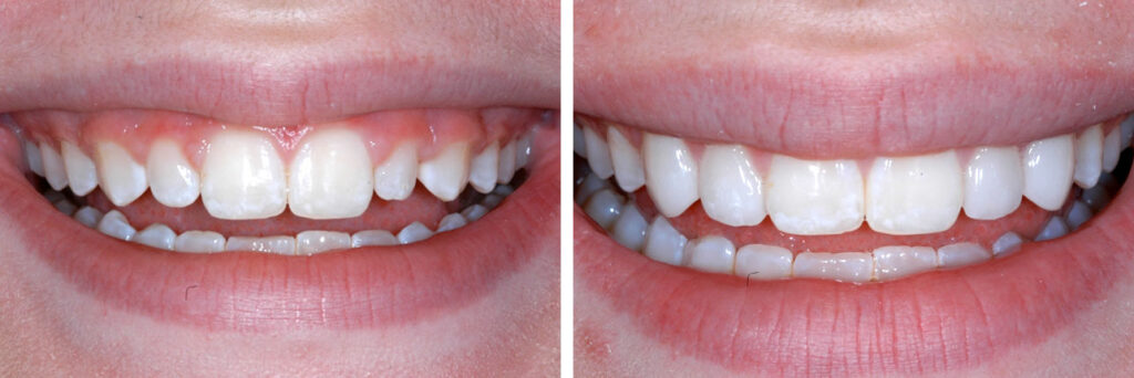 Before And Afters – Durathin Prepless Veneers